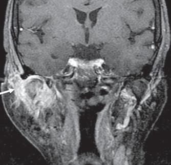 RM e TC da articulação temporomandibular: além da disfunção Figura. Artrite piogênica. Imagem coronal ponderada em T1 com supressão de gordura após injecão de contraste paramagnético.