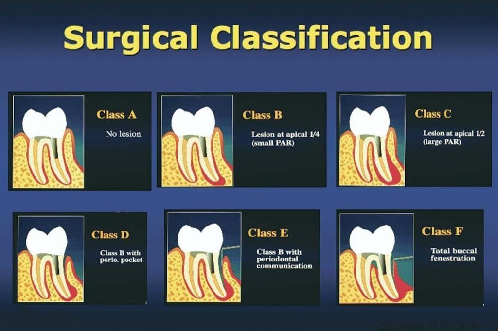 A cirurgia Endodôntica pode ser classificada de acordo com seis classes distintas. Cada caso apresenta um tipo de tratamento e prognóstico diferentes (Kim, 2006).