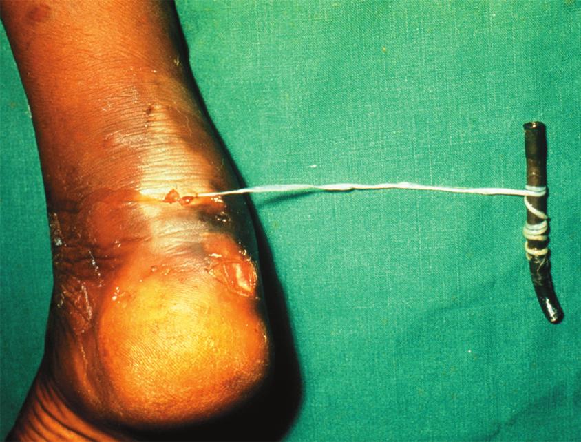 Imunologia (a) Um verme parasítico da Guiné (Dracunculus medinensis) é removido do tecido subcutâneo de um paciente e enrolado em um pedaço de vara.