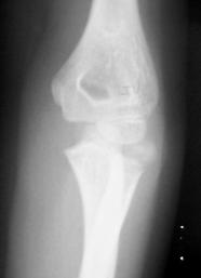 DESCRIÇÃO DO CASO Paciente com 9 anos de idade foi encaminhada ao Serviço de Ortopedia e Traumatologia, com perda da função do cotovelo esquerdo e dor há 5 meses.