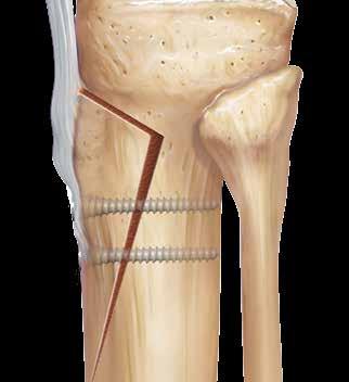 Finalize a osteotomia proximal em direção medial e lateral