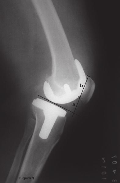 Rev Bras Ortop. 2013;48(3):251-256 253 peripatelar. Em 35 joelhos (66,04%) o ligamento cruzado posterior (LCP) foi preservado e em 18 (33,96%), sacrificado.