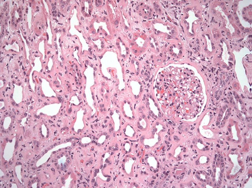 31 Figura 3. Nefrotoxicidade por tenofovir.