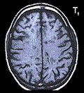 relevância para tumores intracranianos)