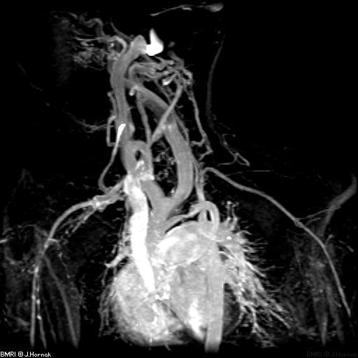 Sistema Cardiovascular Avaliação de acidentes vasculares cerebrais (AVC) - exame de segunda linha Miocardites agudas Observação do