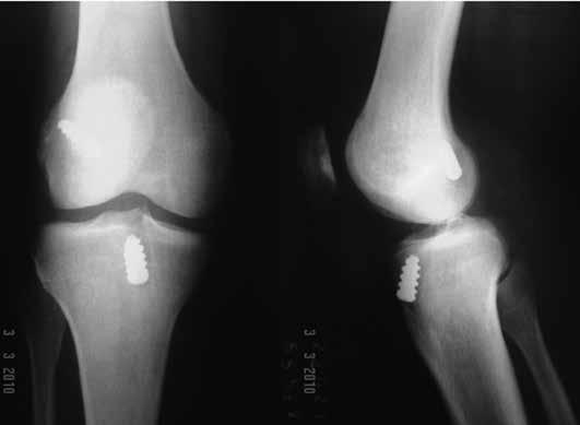 RECONSTRUÇÃO ANATÔMICA DO LIGAMENTO CRUZADO ANTERIOR DO JOELHO: BANDA DUPLA OU BANDA SIMPLES?