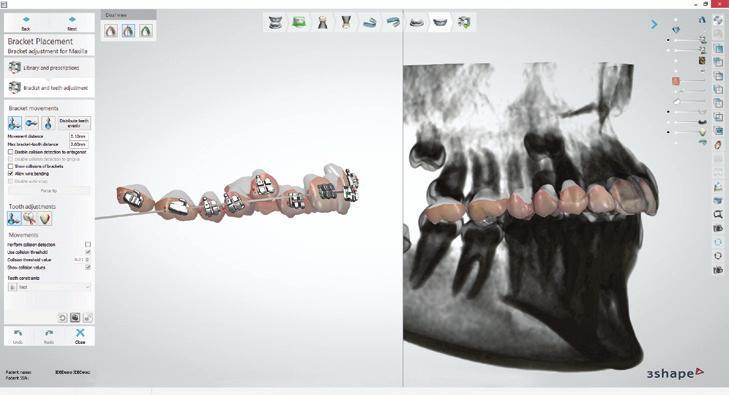 Oferecendo mais serviços aos seus pacientes e parceiros Aproveite-se dos fluxos de trabalho digitais perfeitamente integrados com os escaneamentos do 3Shape X1 e o software da 3Shape para implantes e