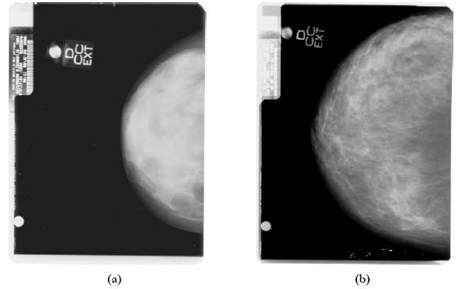 10 Figura 2.3 - Imagens de mamas com diferentes densidades: (a) mama densa, e (b) mama não densa.