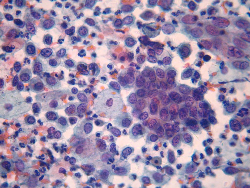 26 Figura 2 - Grupamentos de células escamosas atípicas e, no fundo, infiltrado inflamatório neutrofílico: compatível com lesão intraepitelial de alto grau não podendo afastar microinvasão
