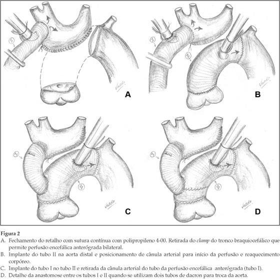 a uma temperatura de 20 a 25 C. A porção distal da aorta é seccionada e preparada para receber a prótese tubular de dacron (tubo II).