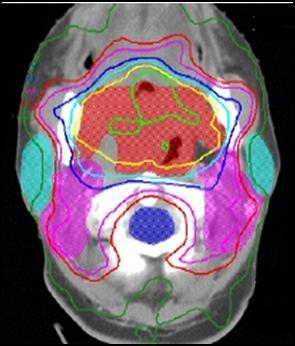 do feixe de radiação emitido pelos aceleradores lineares. Este objetivo foi atingido através da radioterapia de intensidade modulada (IMRT, do inglês Intensity Modulated Radiation Therapy).