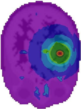 Analisando a Figura 22 é possível notar que a maior dose ocorreu no tumor, que recebeu uma dose média 8,5 vezes e 21 vezes maior do que o tecido adjacente e o tecido normal, respectivamente.