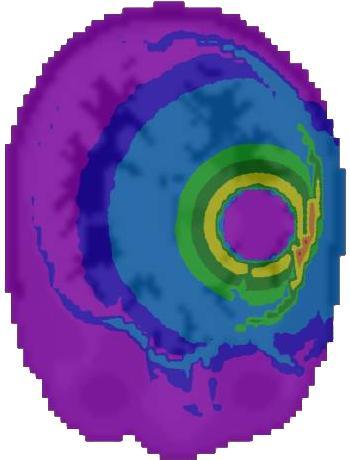 de ter sido solicitado ao código MCNP5 que calculasse a deposição de energia em cada um dos voxels do modelo (tally F6).