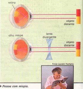 Anomalias Miopia: capacidade de refração do olho muito grande em relação ao seu comprimento, a imagem forma-se antes da