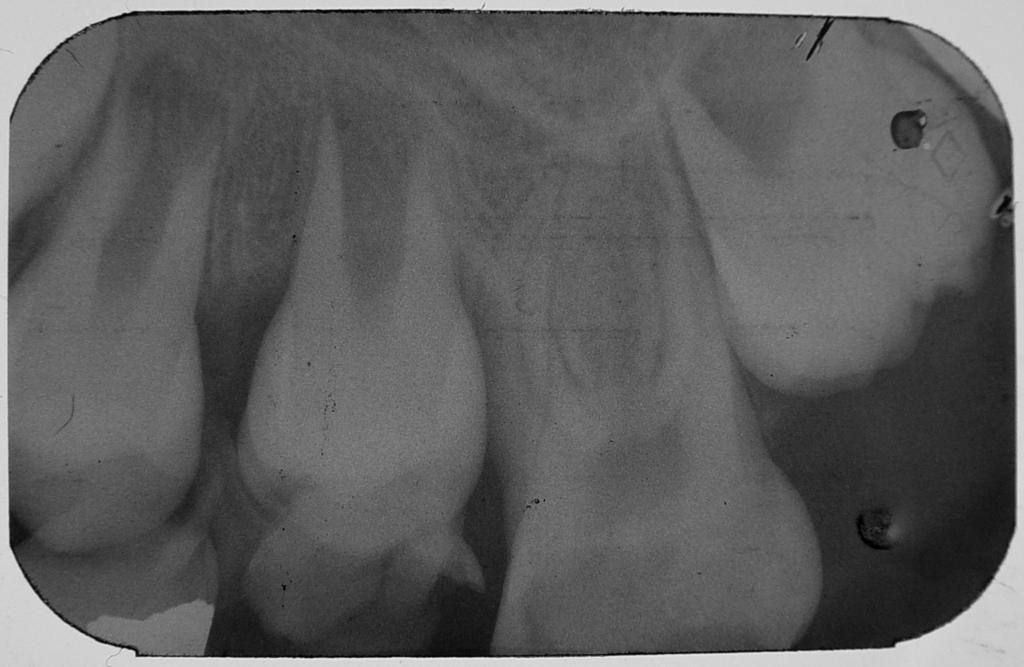 232 INTRODUÇÃO O amálgama, como material restaurador, foi introduzido na Odontologia em 1926 e, ainda hoje, é o material de escolha para a restauração de dentes posteriores em função das suas