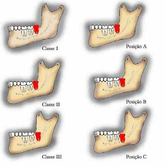 A impactação mesio-angular está mais relacionada com a parestesia lingual, atingindo 30% dos casos. A Figura 2 mostra a classificação de Pell e Gregory.