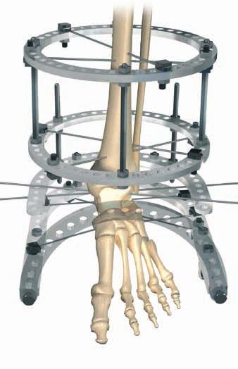 TÉCNICA CIRÚRGICA 9 9 8 7. AJUSTE DA PLACA DE PÉ PROXIMAL Ajuste o nível proximal da placa de pé conforme necessário para assegurar que ela intersecciona a cúpula do talus. 8. INSERIR FIOS ATRAVÉS DO TALUS Insira o primeiro fio com oliva (8) em sentido láteroposterior para médio-anterior.