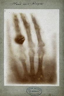 Colocando a mão da esposa entre a fonte de raios X e um filme fotográfico, ele conseguiu produzir a primeira radiografia da