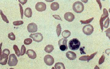 Na anemia falciforme houve uma mutação de ponto que causou a substituição do ácido glutâmico por valina.