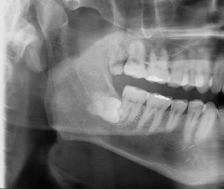 Controle radiográfico foi realizado anualmente e, 3 anos após a cirurgia, evidencia-se completa neoformação óssea local, sem migração das raízes