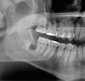 Confirmada esta suspeita com uma tomografia computadorizada cone beam, (Figura 5), foi indicada a realização de uma coronectomia.