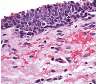 25 6 ATROFIA Atrofia é um fenômeno normal associado à idade resultante da ausência de estimulação hormonal, com consequente estreitamento do epitélio.