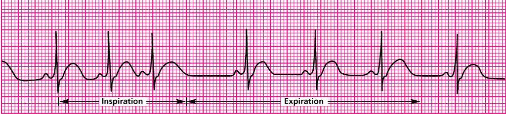 2 Tipos Arritmia Sinusal Respiratória ou Fásica: - Associada a uma variação respiratória (ritmo irregular, FC: inspiração e expiração) - ++ jovens, diminui com a idade - Geralmente assintomática