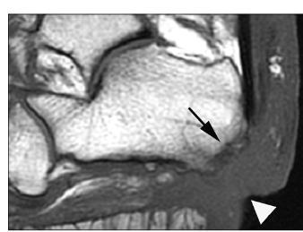 Osteomielite calcâneo