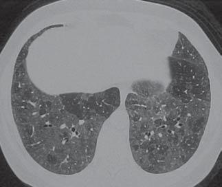 - pneumonite por hipersensibilidade crônica TABELA 2 TCAR de tórax na pneumonite por hipersensibilidade (99casos) Achados tomográficos Nº.