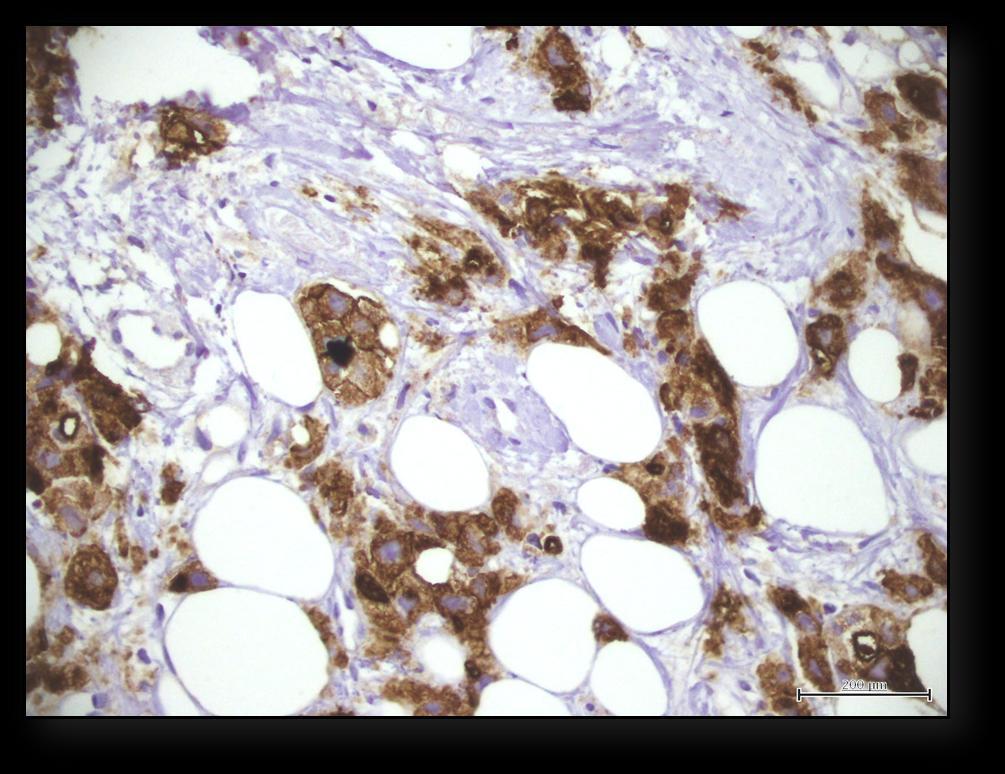 104 Figure 8: CD24 mainly cytoplasmic staining (400X). CD44 and CD24 expression and their association with the clinical and pathological variables of this study are shown in Table 6.