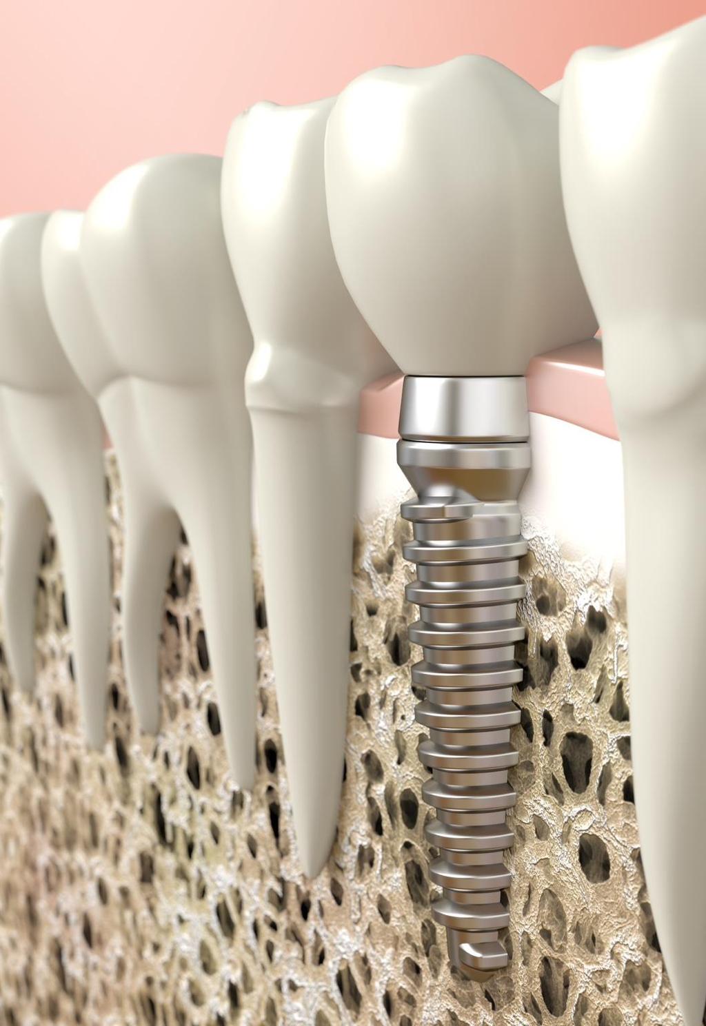 Tipos de enxertos O enxerto ósseo pode contribuir para aumento de volume ósseo em regiões onde exista demanda reconstrutiva prévia à instalação de implante.