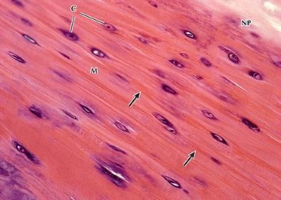 FIBROCARTILAGEM Acidofilia/eosinofilia Fibrocartilagem: Colágeno tipo I, poucos proteoglicanos e pouca água Ausência de pericôndrio Discos