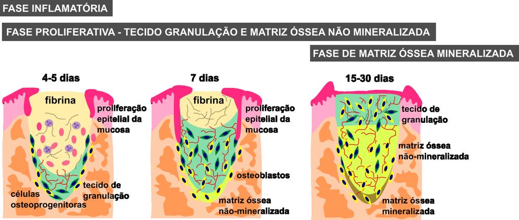 Reparo do alvéolo após extração