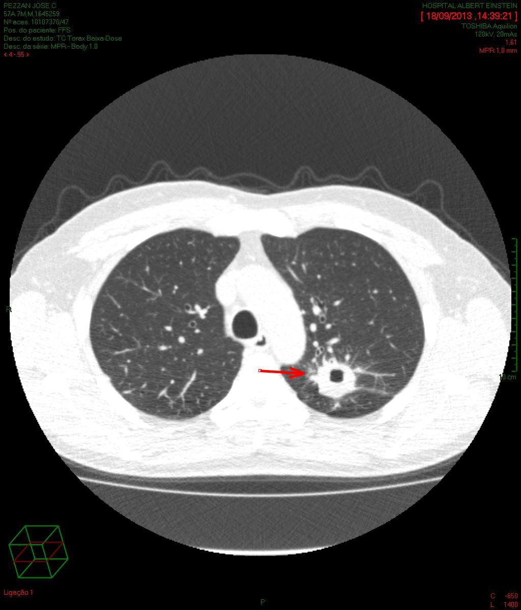 23 (tabela 3). Além dos dois casos de tuberculose diagnosticados com biópsia e lavado bronco-alveolar (BAL), um caso foi adicionalmente diagnosticado com exame de escarro.