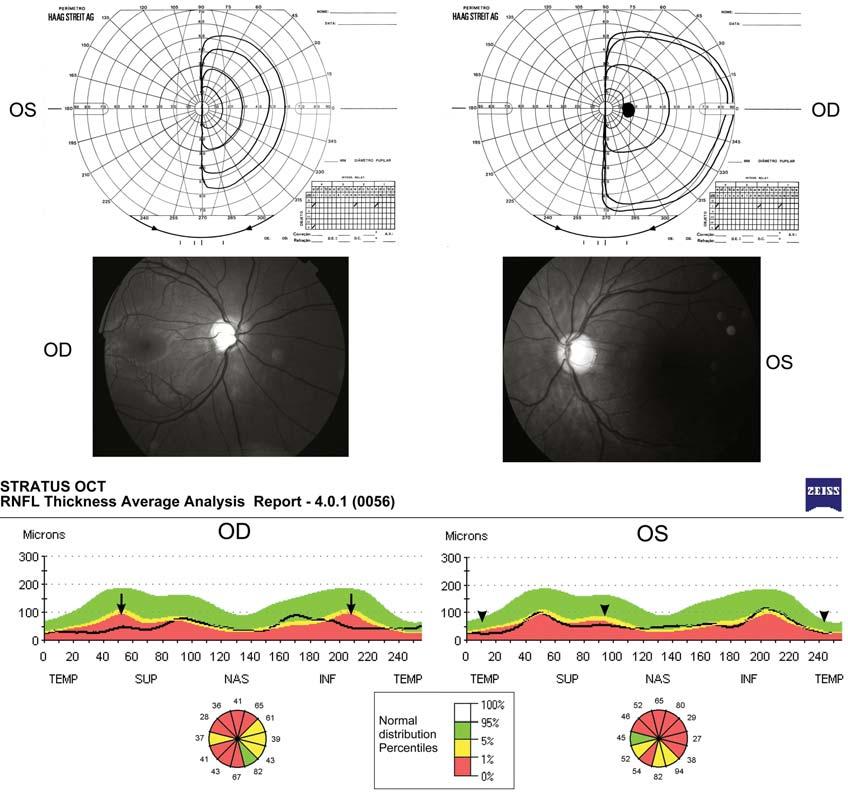 50 Monteiro MLR, Hokazone K Figure 1: Case 1 - Goldmann visual fields showing complete left homonymous hemianopia.