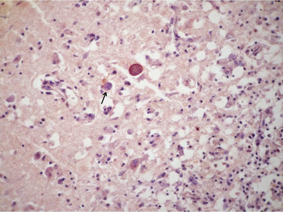 110 Figura 11 Cérebro de cão (animal D) mostrando marcação imuno-histoquímica anti-neospora caninum