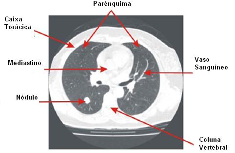 24 Na sistematização da avaliação do nódulo pulmonar, a tomografia computadorizada (TC) é o método não-invasivo mais utilizado para caracterização do nódulo e do mediastino, facilitando enormemente o