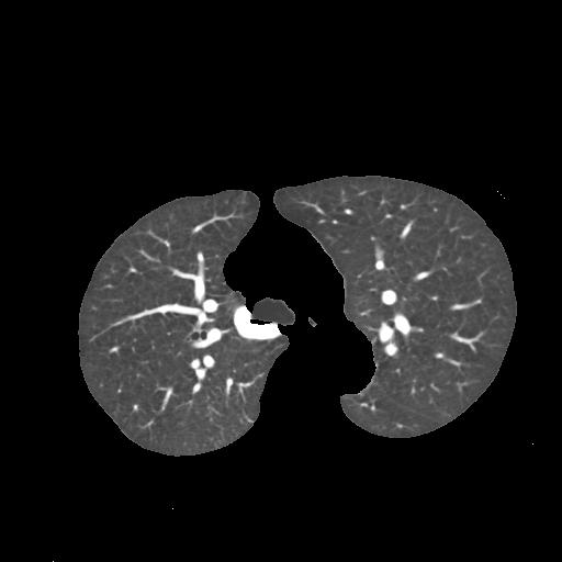 62 Figura 3-8. Imagem resultante da redução do VOI 3.3. Segmentação A segmentação do nódulo pulmonar é composta por duas fases.