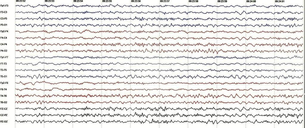 37 Tabela 7 - Fenótipo epiléptico e mutações provavelmente deletérias dos sujeitos do estudo Epilepsias idiopáticas com crises precipitadas por febre: caracterização clínica, eletroencefalográfica e