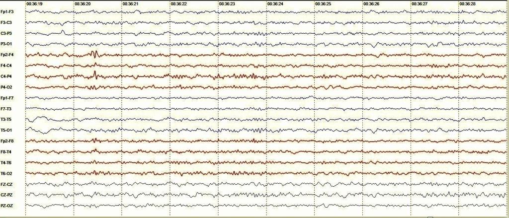 38 Figura 2 Amostra de EEG do sujeito n 9. Sonolência.