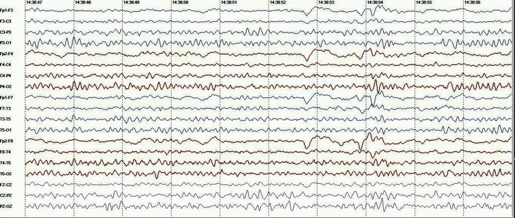 fronto-central direita Figura 3 Amostra de EEG do