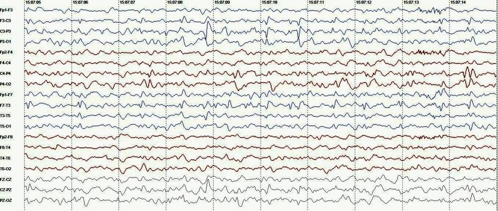 39 Figura 4 Amostra de EEG do sujeito n 1. Sono.