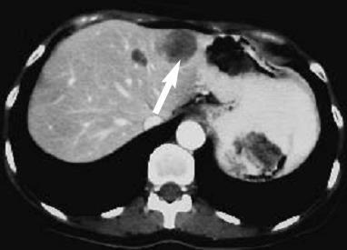 Figura 3. Tomografia computadorizada abdominal, após a ingestão e a injeção intravenosa de meio de contraste iodado: múltiplas lesões nodulares hepáticas, hipocaptantes de meio de contraste.