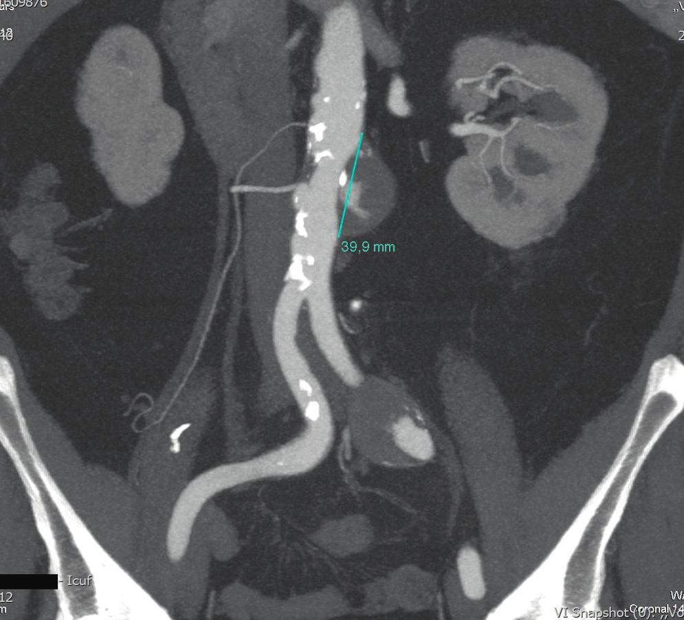 Tratamento endovascular de aneurismas saculares isolados da aorta abdominal 31 A literature review is performed on the level of evidence of the treatment of saccular aneurysms and made reference of