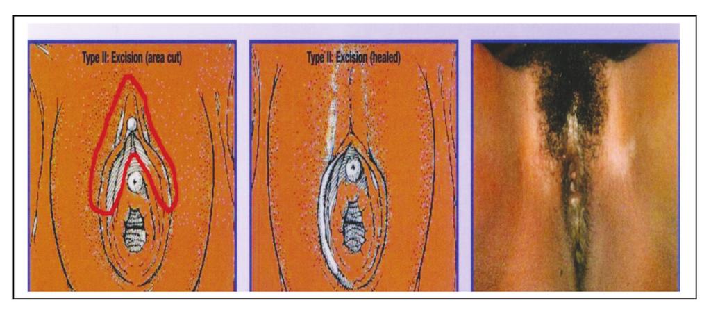 Campos AC Quadro II Quadro III Tipo I Remoção total ou parcial do clítoris e/ou do prepúcio (clitoridectomia) Tipo II Remoção total ou parcial do clítoris, dos pequenos lábios, com ou sem excisão dos