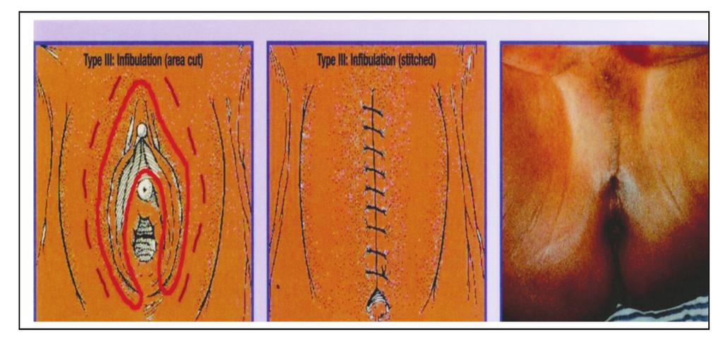 do clítoris (infibulação). Tipo IV todas as outras intervenções nefastas sobre os genitais femininos, por razões não médicas.