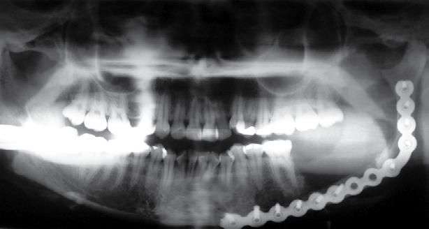 252 Corrêa, Brust e Jesus Rev Odontol UNESP. 2010; 39(4): 247-254 Figura 10. Radiografia panorâmica sem sinal de recidiva após 12 meses do procedimento cirúrgico. Figura 11.