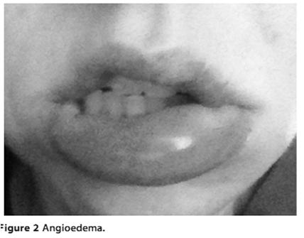 Prostaglandinas Leucotrienos Citocinas Óxido Nítrico Angioedema Sintetizada em 1907