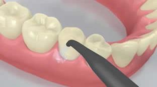 O excesso de material com aparência de gel pode ser facilmente removido com uma cureta. Como todos os compósitos, Multillink Speed é sujeito à inibição pelo oxigênio.