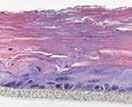 apoptóticas no interior da camada epidérmica basal, denominadas sunburn cells (SBCs) é outra